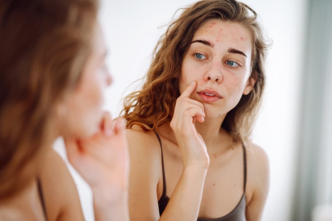 Comment traiter une poussée d'acné juste avant son mariage ?